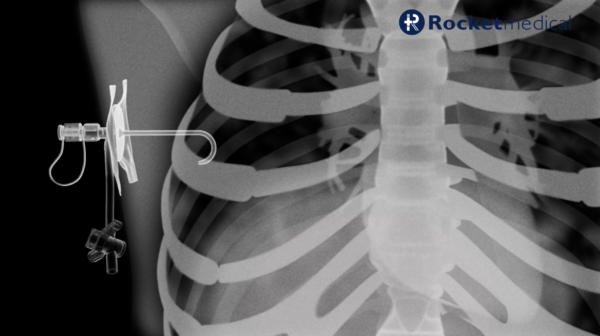 B53 - Percutaneous Aspiration of Pleural Effusion Showcase - Scientific ...